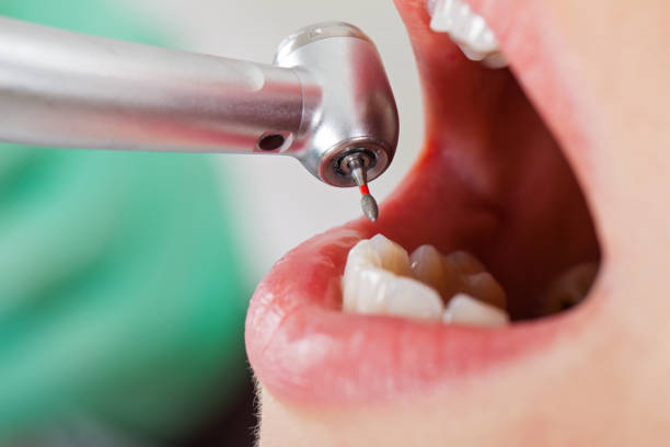 Best Emergency Treatment for Toothache in Salina, UT
